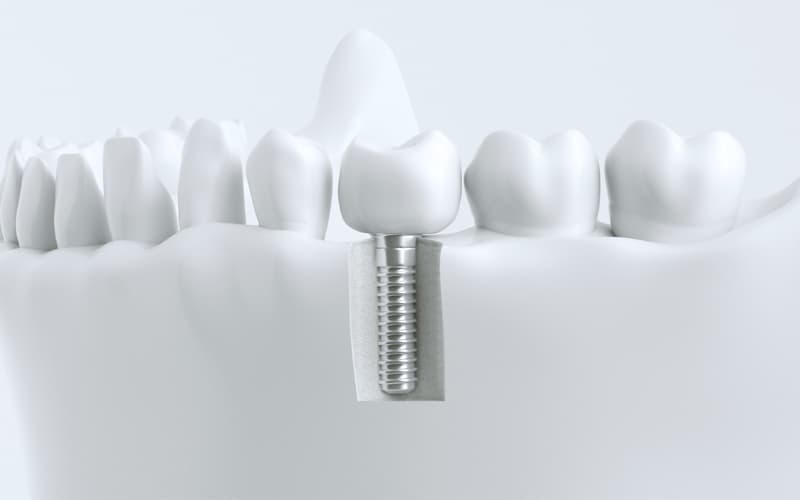 Implantología y periodoncia